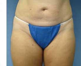 St Louis Abdominal Liposuction Procedures